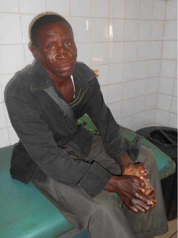 Young man with early leprosy in Gabon in 2015. Author’s photo taken with permission of patient.