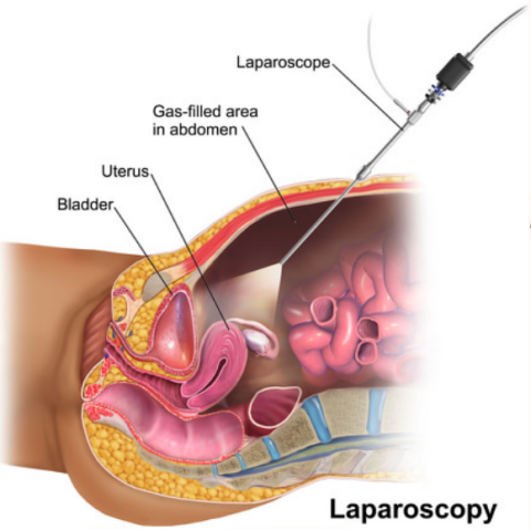 Laparoscopy