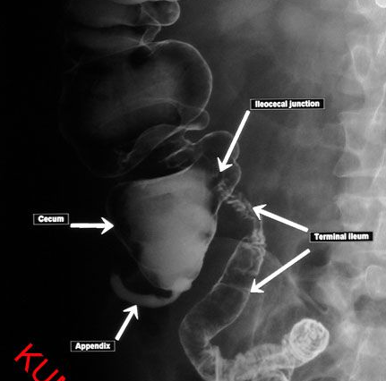 fig 2 x-ray appendix