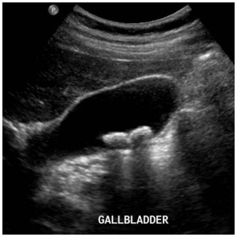 Ultrasound gallstones