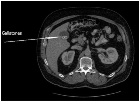 CT scan gallstones