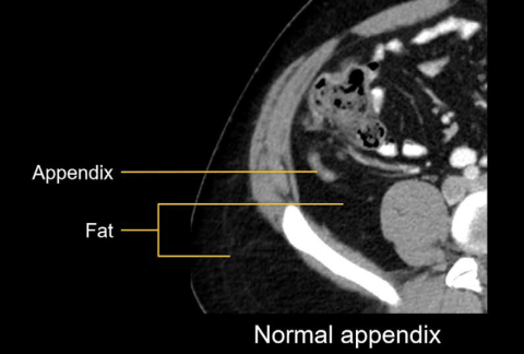 fig 3 x-raay appendix