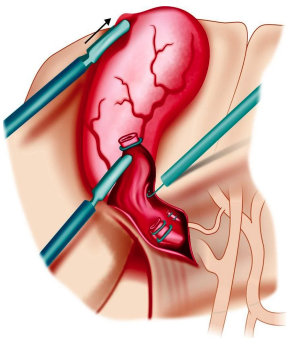 Gallbladder through scope